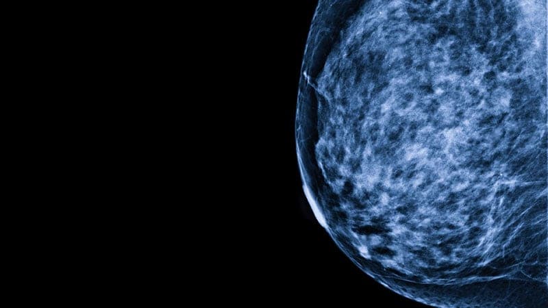Estudo indica relação entre densidade mamária e risco de câncer de mama em idosas